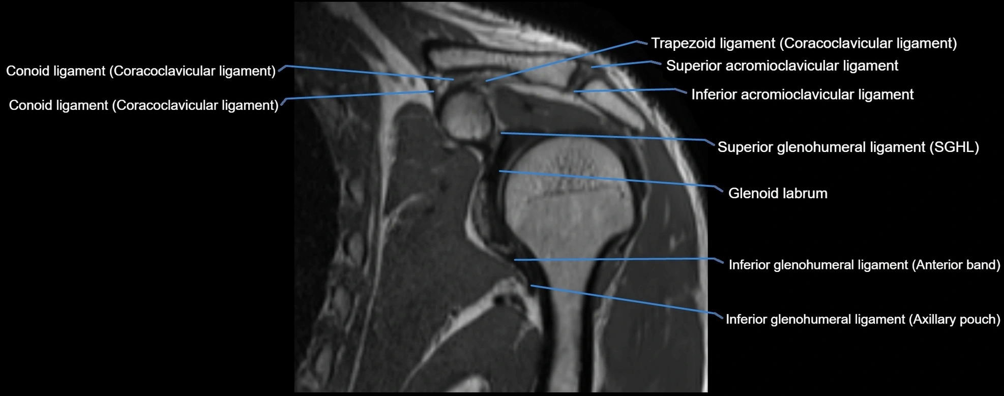 shoulder ligments coronal  cross sectional anatomy 3T MRI AI enhanced radiology image -img-00001-00024.webp